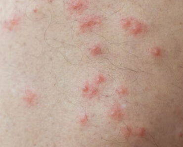 How To Identify 10 Of The Most Common Bug Bites