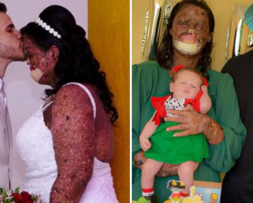 Woman with rare skin condition overcomes negativity and finds true love